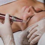 Microneedling